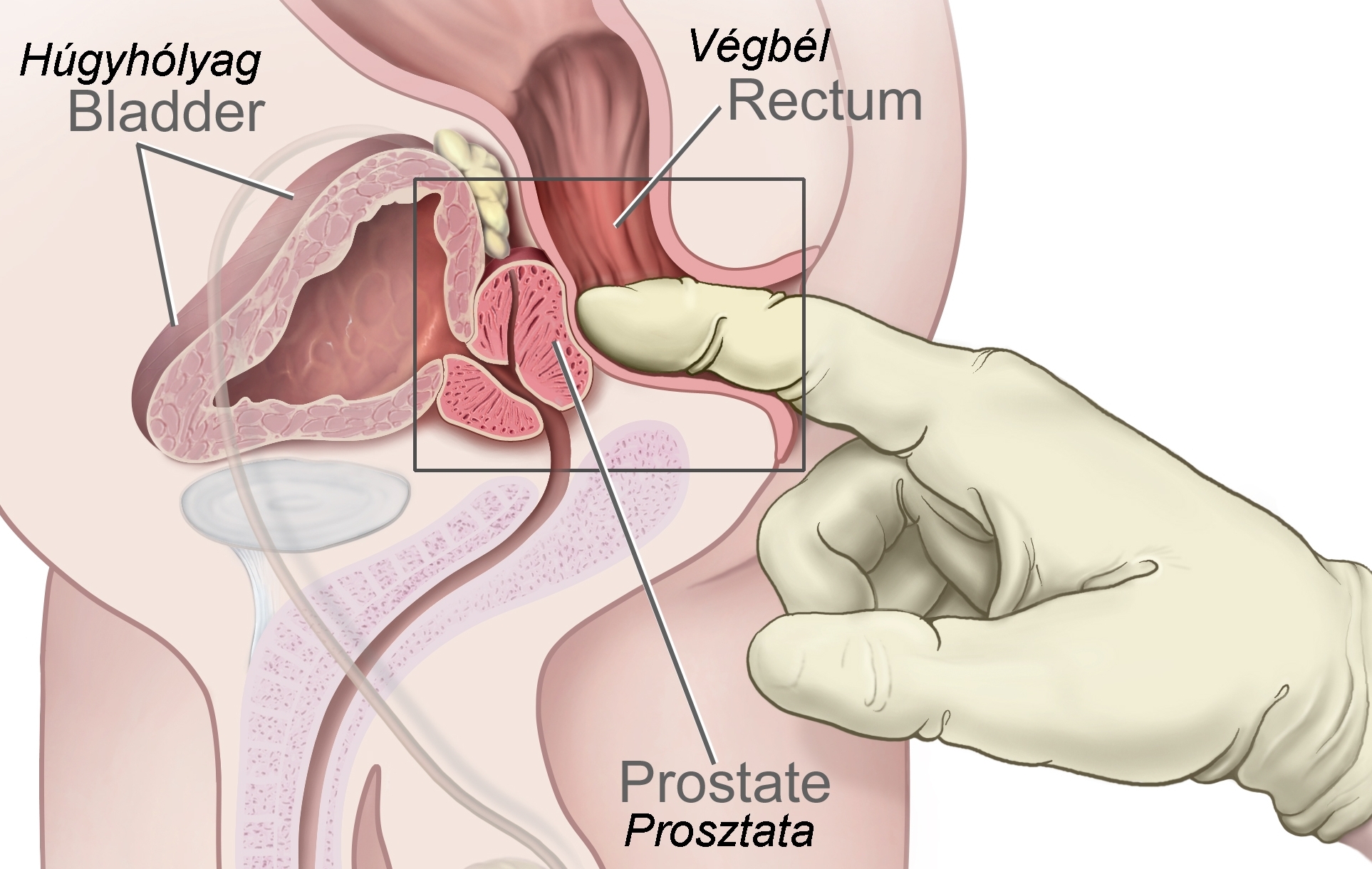 Fájdalom a prosztata biopszia után fájó bél prosztatitis