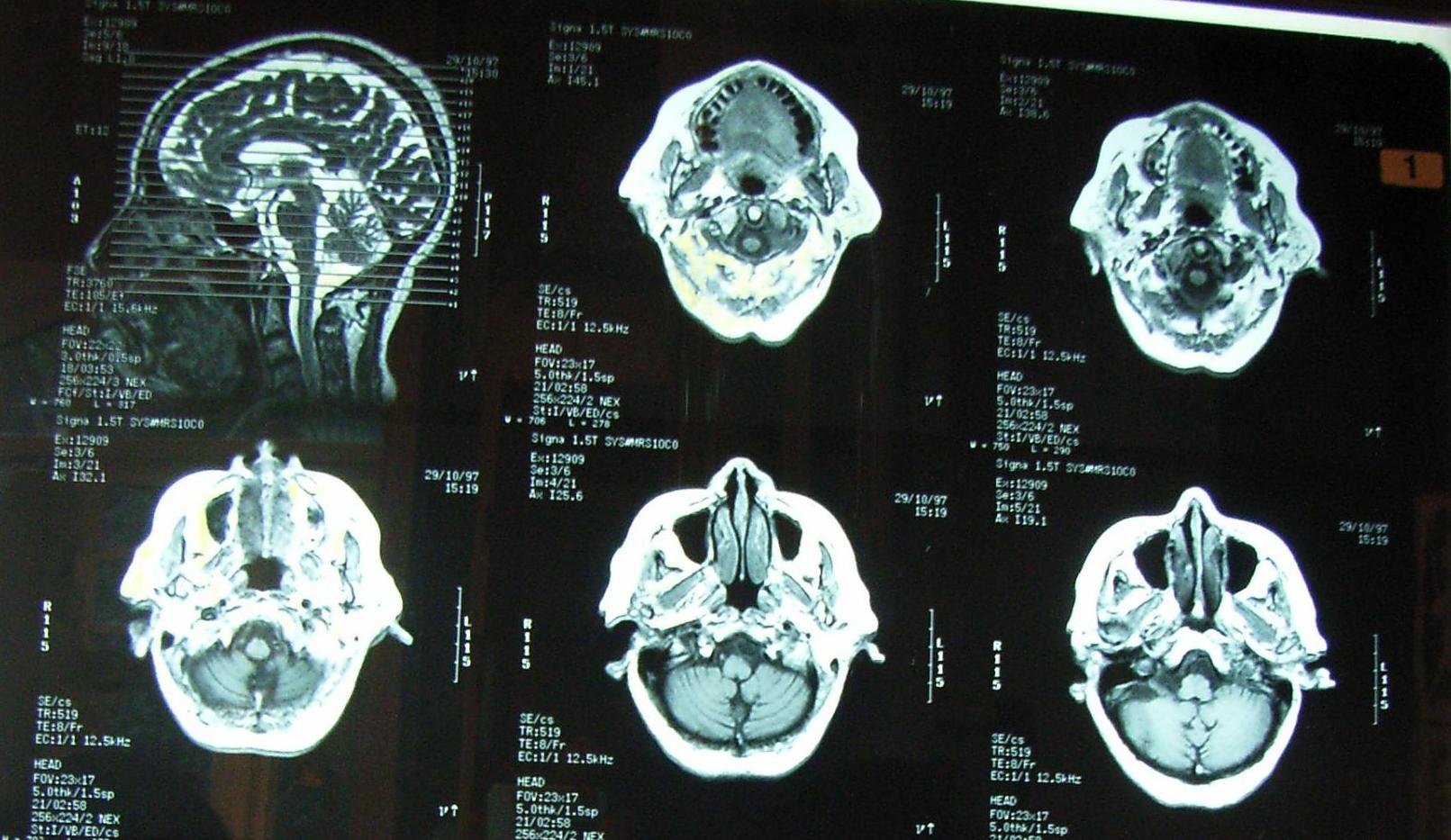 vastagbélrák látható a CT-vizsgálat során
