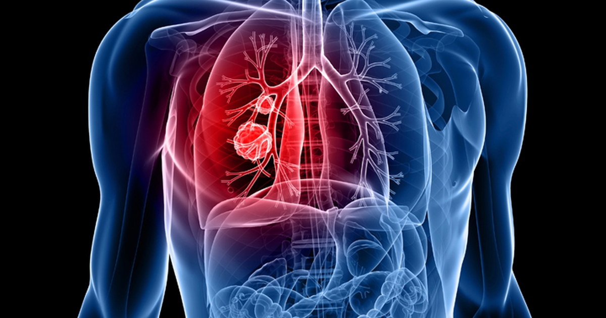 Áttétes tüdőrák, IV stádium (jelige: kata04) | Rákgyógyítás