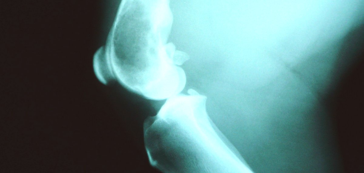 Mi a jellemzője és hogyan kezelhető a csontáttétes prosztatarák? | Rákgyógyítás