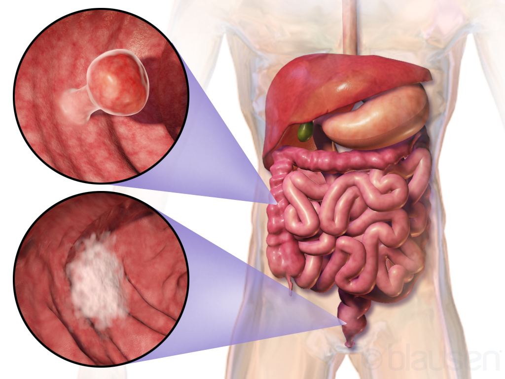 Az epehólyag és az epevezeték daganata - szakaszai és prognózisa