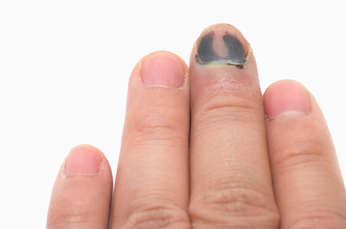 a körmök nem gombásodnak hogyan lehet megkülönböztetni a gomba köröm sérülése