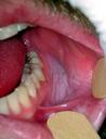 A leggyakoribb problémák a szájban - HáziPatika