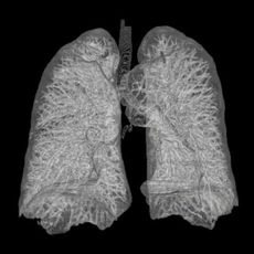 4. tüdőrák - a várható élettartam